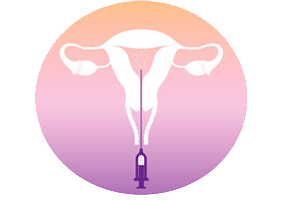 IUI treatment process